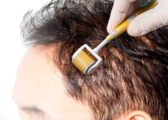 aplicando dermaroller para la alopecia la cawa lacawa
